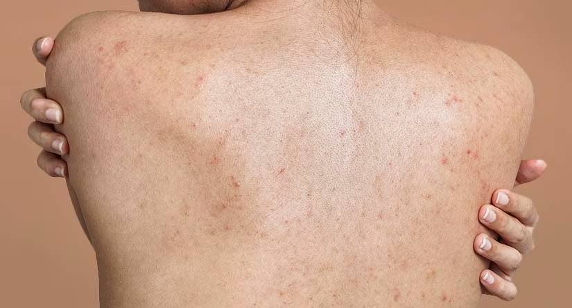 Vue de dos d'une personne à la peau claire présentant de l'acné sur le dos, ses mains sur ses épaules.