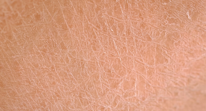 Très gros plan sur une peau humaine visiblement sèche et squameuse, montrant des craquelures et une texture rugueuse.