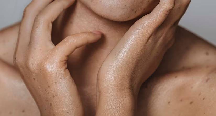 Gros plan sur les mains et le cou d'une personne à la peau constellée de taches de rousseur. Les mains encadrent délicatement le cou.