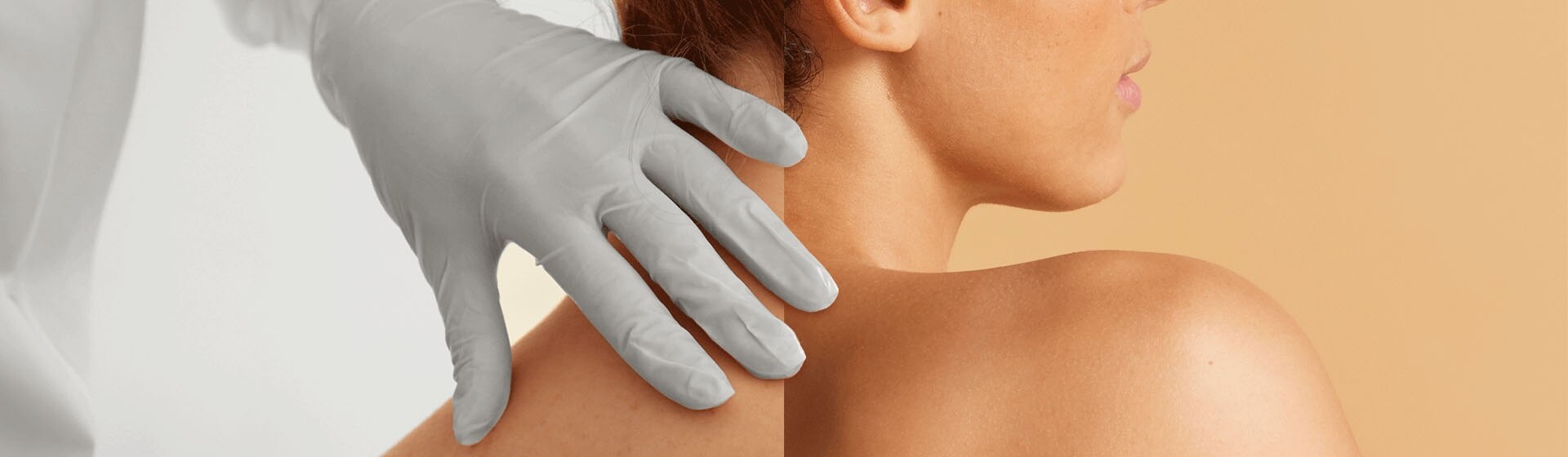 Une main portant un gant médical gris clair est posée délicatement sur l'épaule nue d'une femme, évoquant une expertise dermatologique.