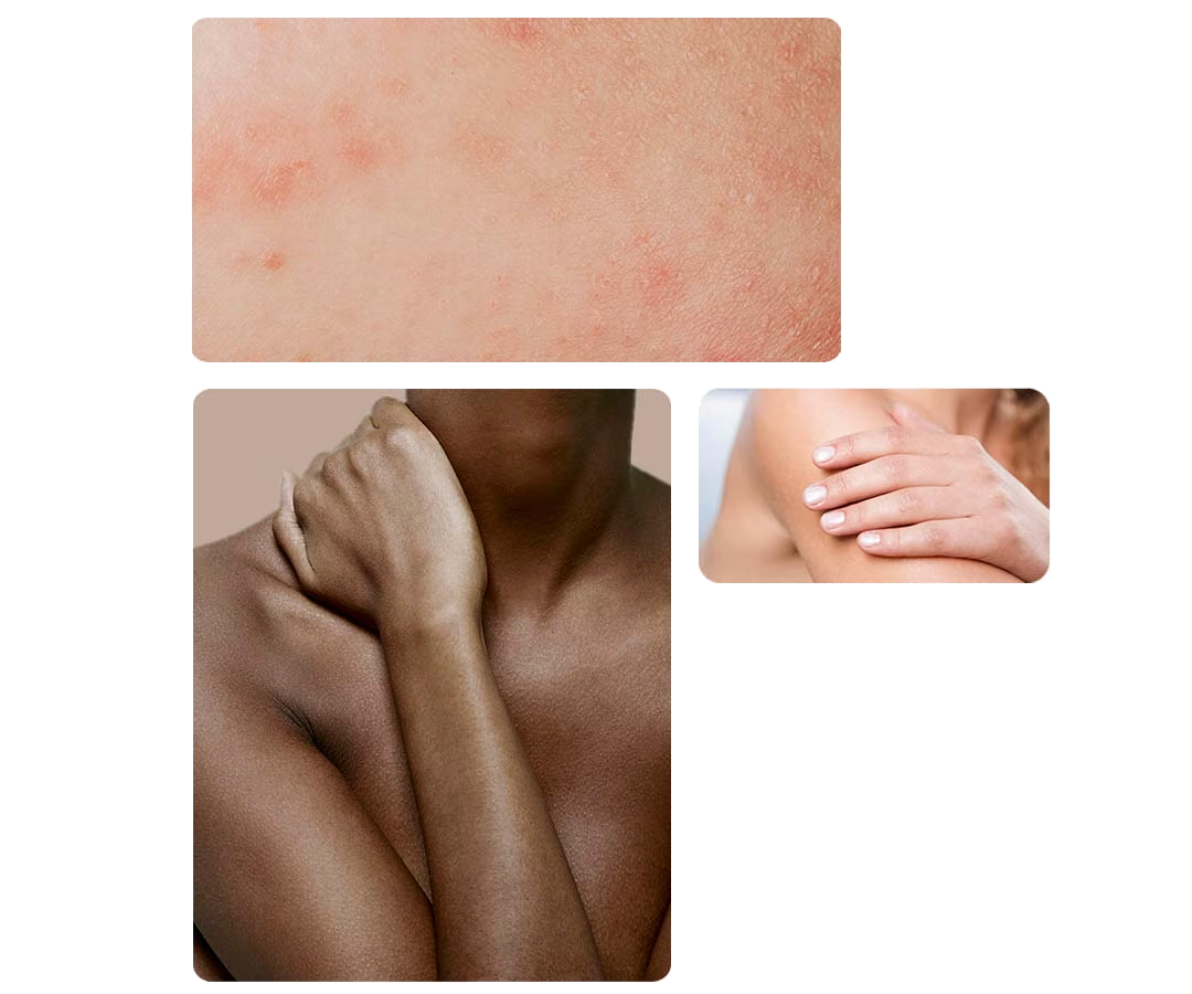 Collage de trois photos illustrant différents aspects de la peau. En haut, un gros plan sur une peau présentant une irritation avec des rougeurs. En bas à gauche, le buste d'une femme noire, sa main posée sur son cou. En bas à droite, la main d'une femme blanche caressant son épaule.