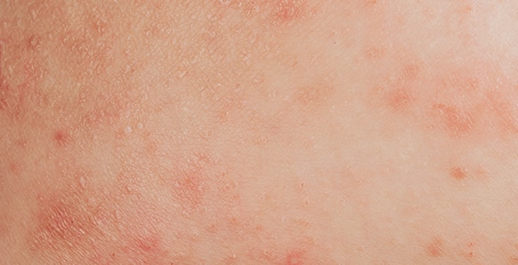 Very dry skin picture