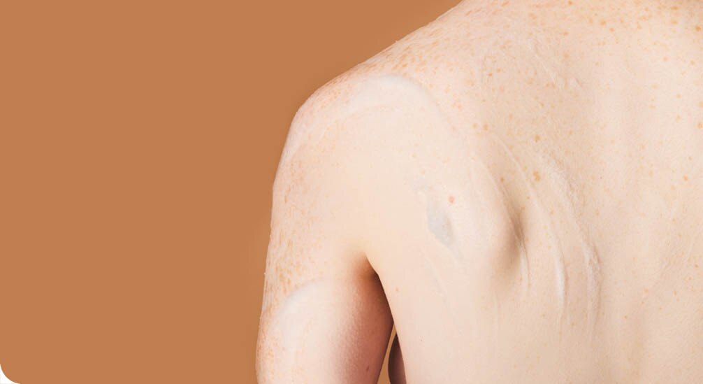 Gros plan sur le dos et l'épaule d'une personne à la peau claire et constellée de taches de rousseur, avec une lotion blanche crémeuse appliquée sur la peau.