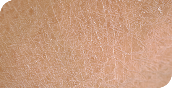 Very dry skin picture