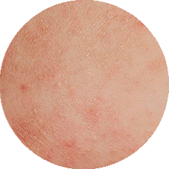 Un cercle montrant en gros plan une peau présentant des rougeurs et des irritations visibles.