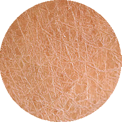 Un cercle montrant en gros plan une peau visiblement sèche, avec des craquelures et un aspect squameux.